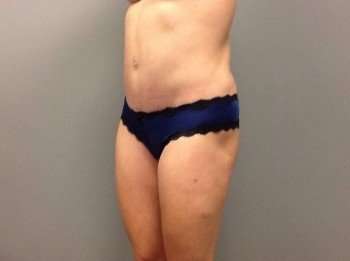 Mommy Makeover Before & After Patient #1450