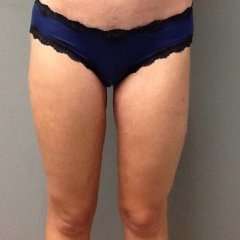 Liposuction Before & After Patient #1485