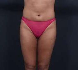 Liposuction Before & After Patient #1492