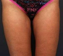Liposuction Before & After Patient #1499
