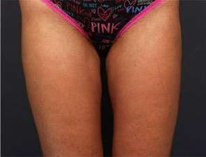 Liposuction Before & After Patient #1499