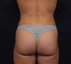 Liposuction Before & After Patient #1506