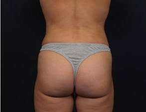 Liposuction Before & After Patient #1506