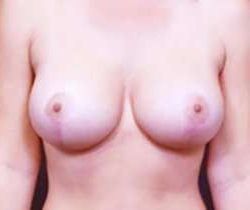 Breast Mastopexy Before & After Patient #209