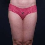 Liposuction Before & After Patient #1513