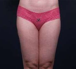Liposuction Before & After Patient #1513