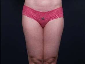 Liposuction Before & After Patient #1513