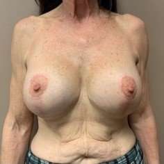 Breast Mastopexy Before & After Patient #221