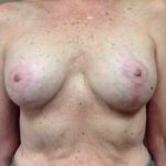 Breast Mastopexy Before & After Patient #228