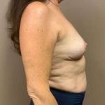 Breast Mastopexy Before & After Patient #80