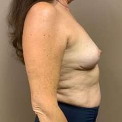 Breast Mastopexy Before & After Patient #80