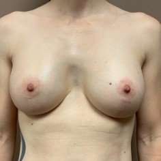 Breast Mastopexy Before & After Patient #252