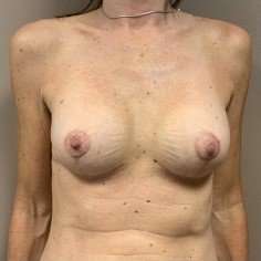 Breast Mastopexy Before & After Patient #266