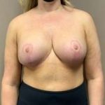 Breast Mastopexy Before & After Patient #302