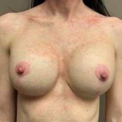 Breast Mastopexy Before & After Patient #345