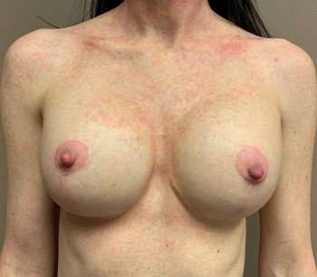 Breast Mastopexy Before & After Patient #345
