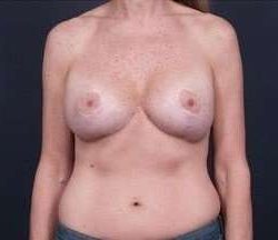 Breast Implant Revision Replacement Before & After Patient #364