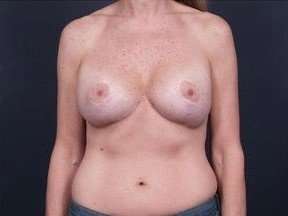 Breast Implant Revision Replacement Before & After Patient #364