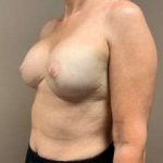 Breast Implant Revision Replacement Before & After Patient #379