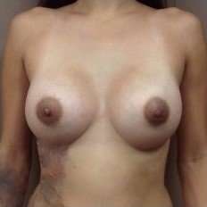 Breast Implant Revision Replacement Before & After Patient #397