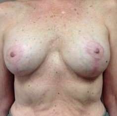 Breast Implant Revision Replacement Before & After Patient #404