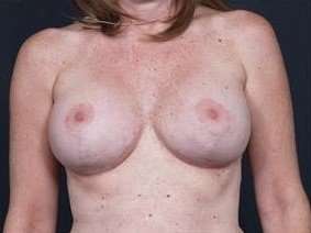 Breast Implant Revision Replacement Before & After Patient #438