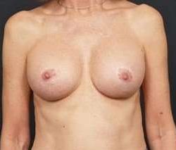 Breast Implant Revision Replacement Before & After Patient #443