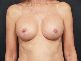 Breast Implant Revision Replacement Before & After Patient #443