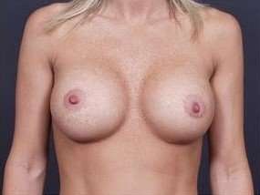 Breast Implant Revision Replacement Before & After Patient #454