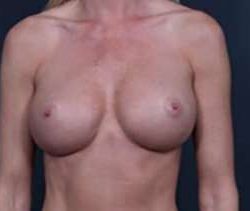 Breast Implant Revision Replacement Before & After Patient #459