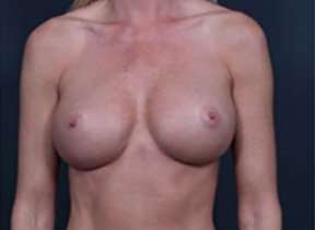 Breast Implant Revision Replacement Before & After Patient #459