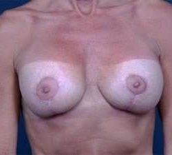 Breast Implant Revision Replacement Before & After Patient #482