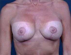Breast Implant Revision Replacement Before & After Patient #482