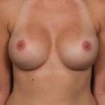 Breast Implant Revision Replacement Before & After Patient #496