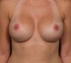 Breast Implant Revision Replacement Before & After Patient #496