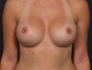 Breast Implant Revision Replacement Before & After Patient #496