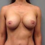 Breast Implant Revision Replacement Before & After Patient #508