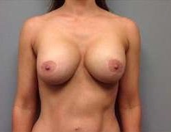 Breast Implant Revision Replacement Before & After Patient #508