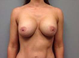 Breast Implant Revision Replacement Before & After Patient #508