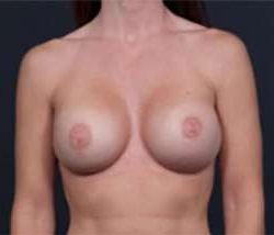 Breast Implant Revision Replacement Before & After Patient #515