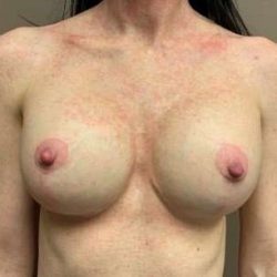 Breast Implant Revision Replacement Before & After Patient #523