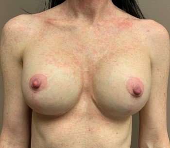 Breast Implant Revision Replacement Before & After Patient #523