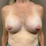 Breast Implant Revision Replacement Before & After Patient #573