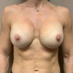Breast Implant Revision Replacement Before & After Patient #585