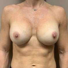 Breast Implant Revision Replacement Before & After Patient #585