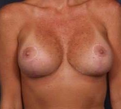 Breast Implant Revision Replacement Before & After Patient #597
