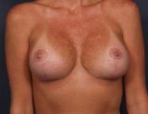 Breast Implant Revision Replacement Before & After Patient #597