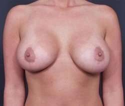 Breast Donut Mastopexy Before & After Patient #605