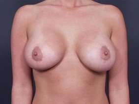 Breast Donut Mastopexy Before & After Patient #605