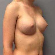 Breast Augmentation Before & After Patient #706
